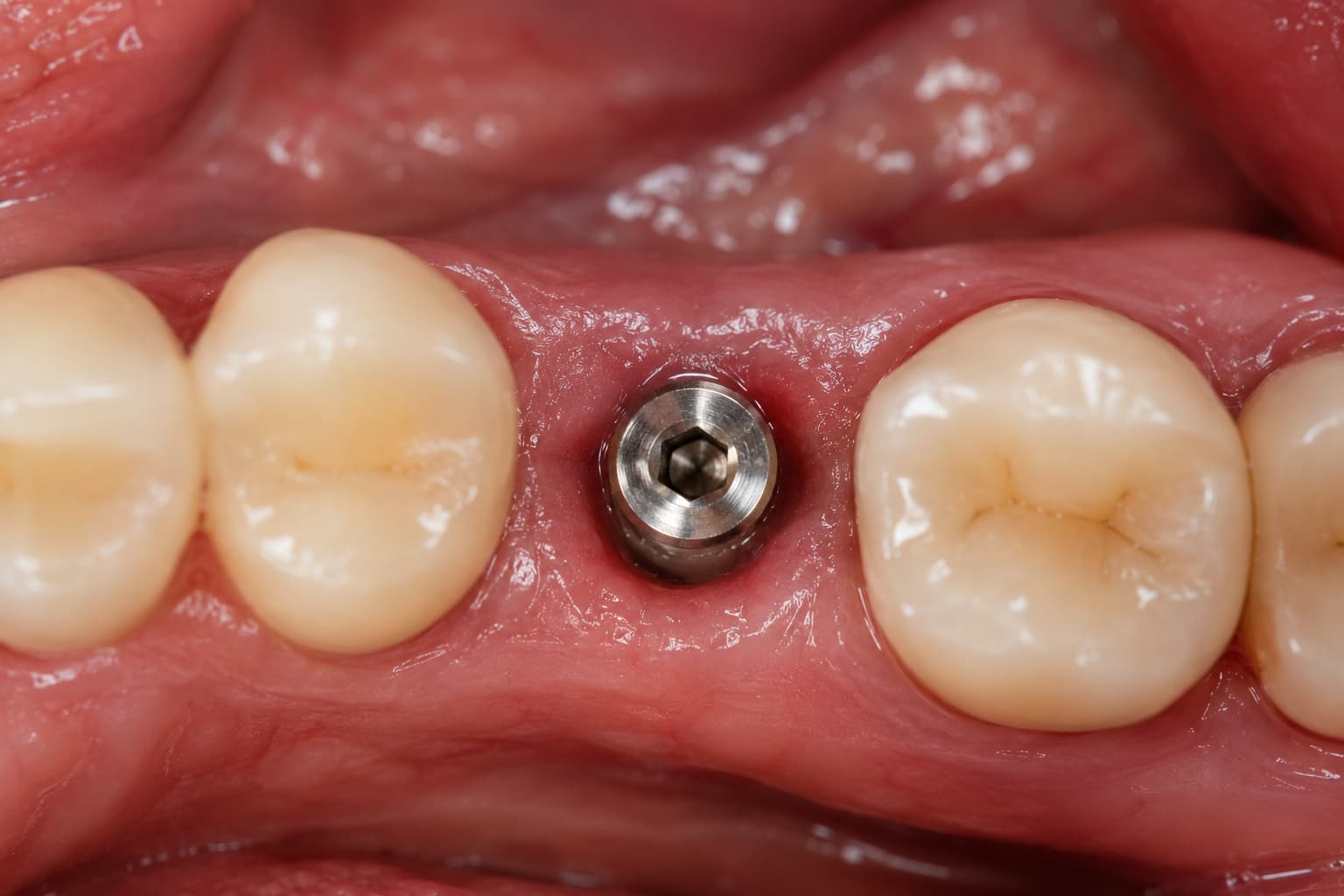 Zubní implantáty se zárukou kvality